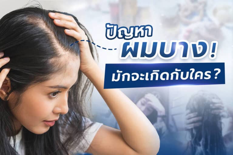 ปัญหาผมบาง มักจะเกิดกับใคร