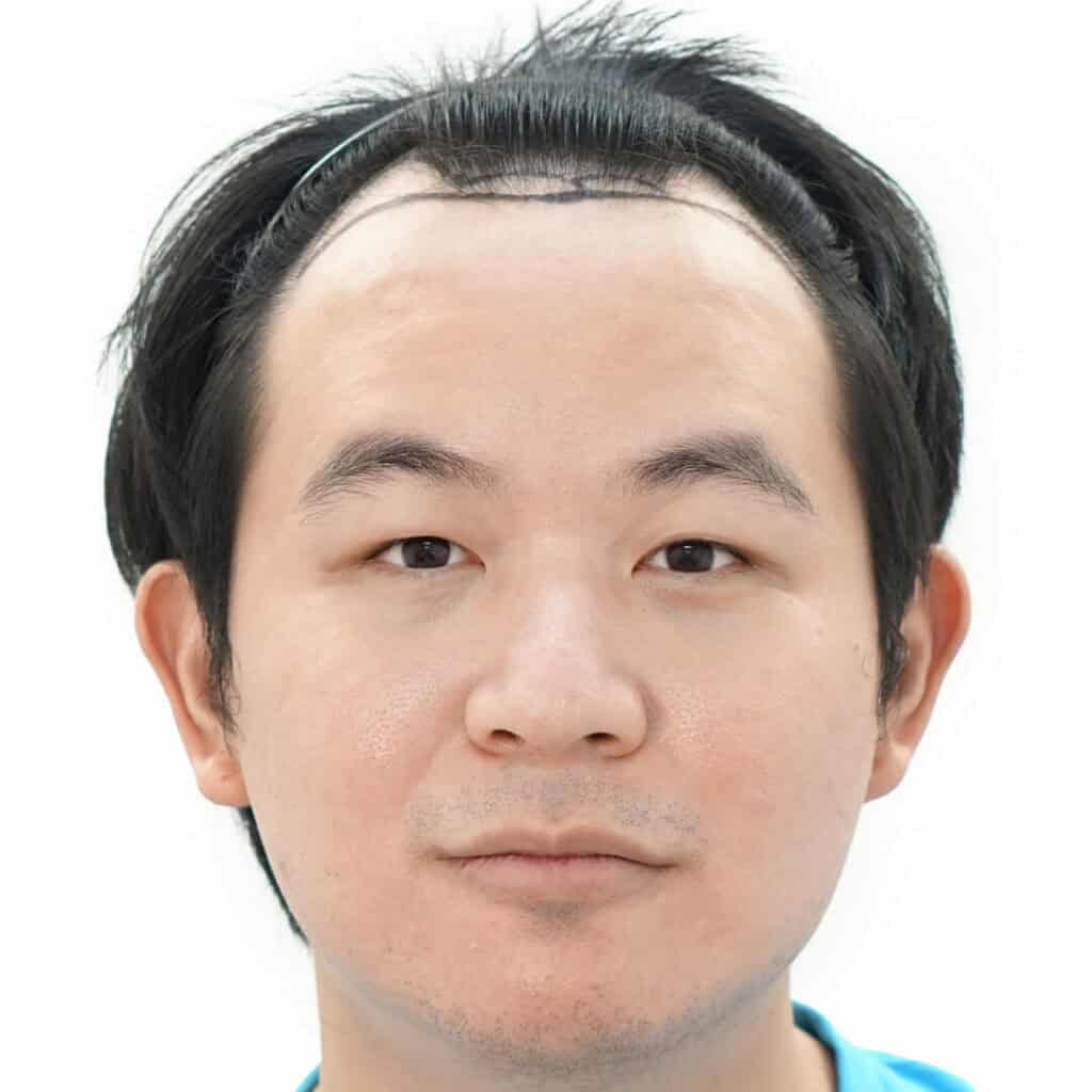 ก่อนปลูกผมด้วยเทคนิค VDHi Non Shaven FUE